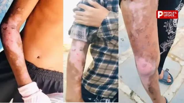 गरियाबंद के आदिवासी छात्रावास में बड़ी लापरवाही,गर्म दाल गिरने से 2 छात्र झुलसे, चेहरे तक जले