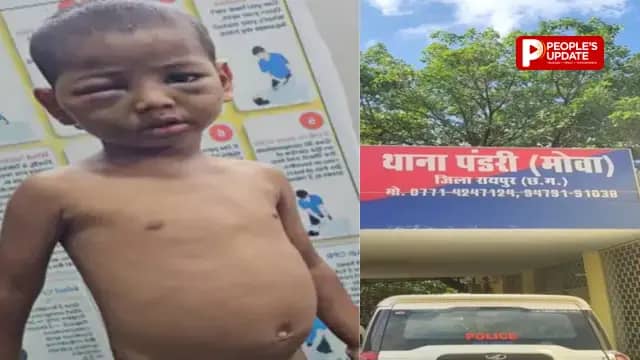 रायपुर में 3 साल के मासूम से मारपीट का आरोप, मां और सौतेले पिता पर FIR, सूजी मिली आंख, हाथ में प्लास्टर