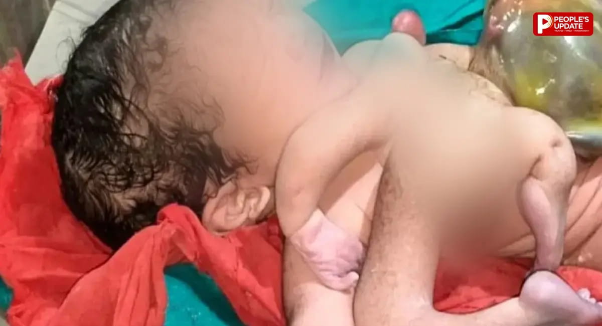 छतरपुर में दुर्लभ जन्म का मामला, बच्चे के चार हाथ और चार पैर; कंजॉइंड ट्विन्स का केस बताया गया