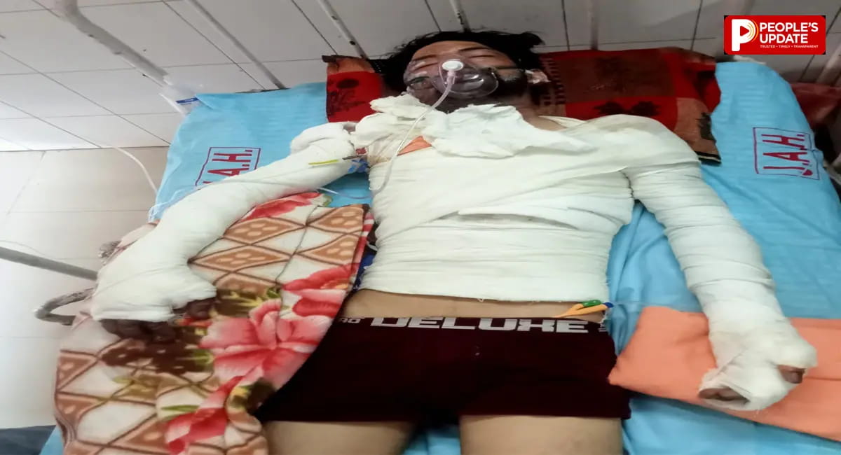 बेटे को बचाने दौड़े पिता भी झुलसे