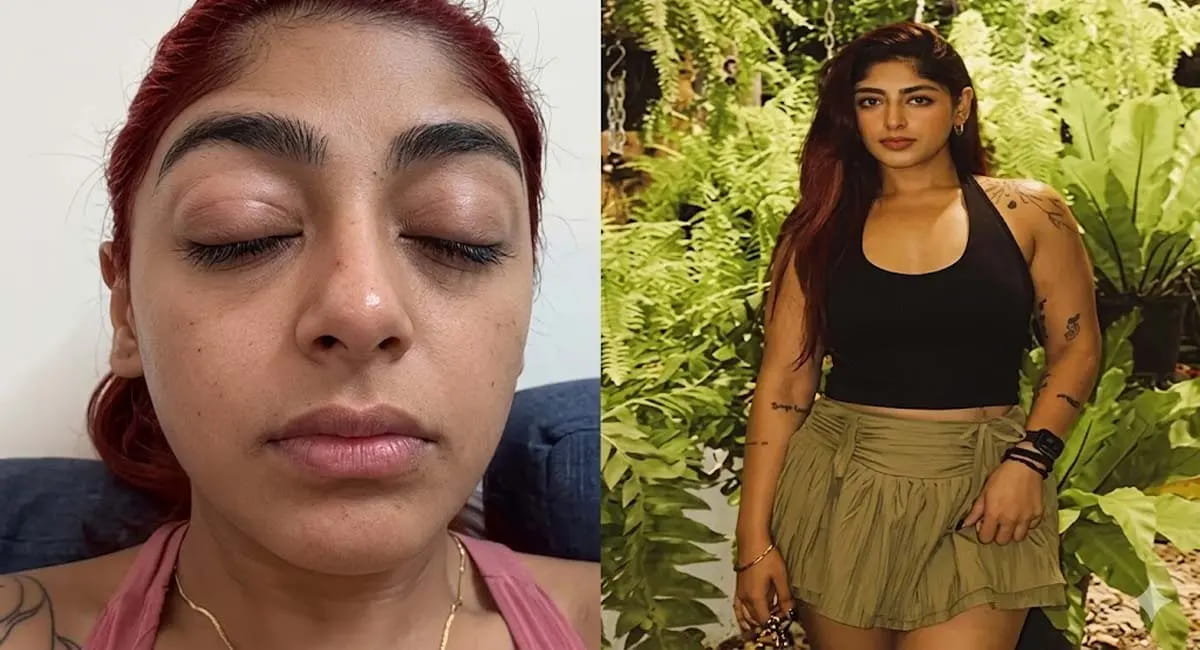 मुंबई क्लब में इंफ्लुएंसर ने एक्ट्रेस को बुरी तरह पीटा, सूजी आंख देख लोग हैरान