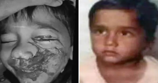 भोपाल में कुत्तों का आतंक : 6 साल के बच्चे का नोंचा जबड़ा... हुआ फ्रैक्चर, तीन दांत भी खा गए; पिता के पास नहीं इलाज के लिए पैसे, मदद मांगने पहुंचे तब हुआ खुलासा