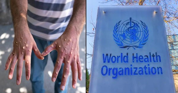 Mpox ने बढ़ाई चिंता... WHO ने ग्लोबल हेल्थ इमरजेंसी घोषित की, दो साल में दूसरी बार किया ऐलान, जानें लक्षण