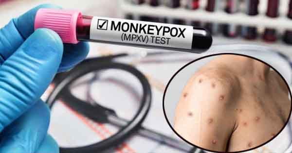 Monkeypox की भारत में एंट्री, विदेश से लौटे शख्स में लक्षण मिले, आइसोलेशन में रखा, जानें स्वास्थ्य मंत्रालय ने क्या कहा