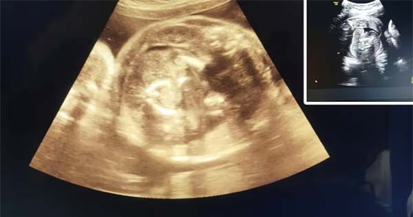 पेट में पल रहे बच्चे के पेट में और एक बच्चा, सोनोग्राफी रिपोर्ट ने डॉक्टर को भी चौकाया, जाने पूरा मामला!