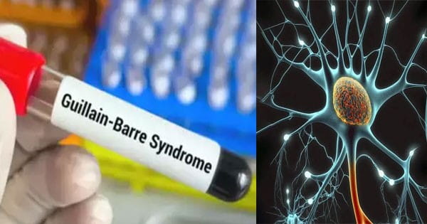 महाराष्ट्र में Guillain Barre Syndrome के 7 नए केस, मरीजों की संख्या बढ़कर हुई 180, अब तक 6 लोगों की मौत