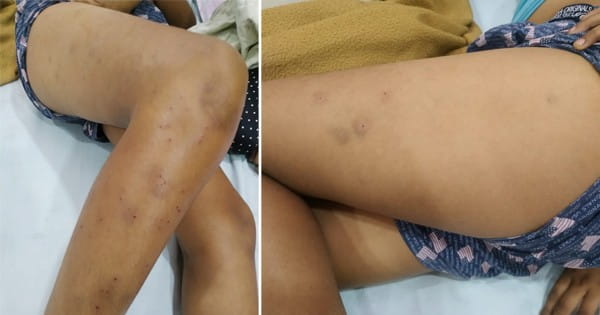 इंदौर : 3 विद्यार्थियों ने मिलकर एक स्टूडेंट पर प्रोटेक्टर से किया हमला, 105 घाव देख परिजन पहुंचे थाने, स्कूल प्रबंधन पर मामला दर्ज