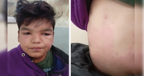 इंदौर : सरकारी स्कूल में विद्यार्थियों को पिलाई आयरन की दवा, कई बच्चों को हुआ रिएक्शन, ICU में करवाया भर्ती
