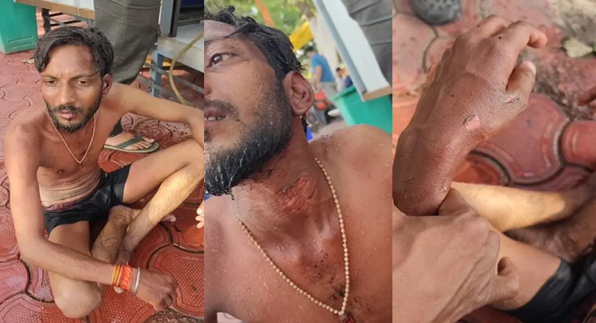 10 नंबर मार्केट का मामला, अतिक्रमण कार्रवाई के बीच दुकानदार ने खुद को लगाई आग; प्रशासन पर उठे सवाल