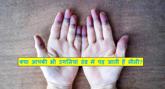 सर्दियों में उंगलियां क्यों पड़ जाती हैं नीली? जानिए रेनाड्स सिंड्रोम का सच