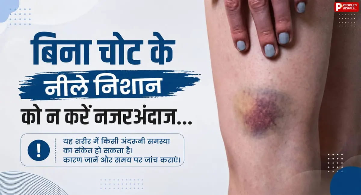 शरीर पर बिना चोट के पड़ रहे हैं नीले निशान? गंभीर बीमारी की चेतावनी...!