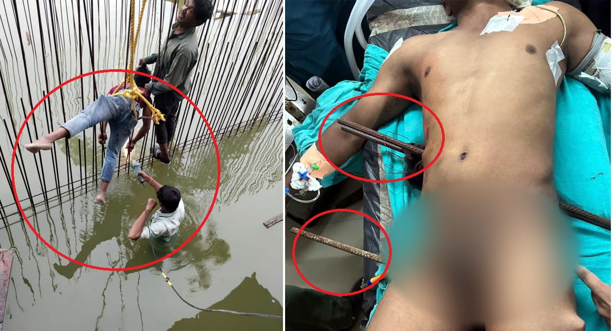 शरीर से हो गए थे 3 सरिये आरपार:- एम.वाय.के डॉक्टरो ने मौत के मुंह से वापस लाए