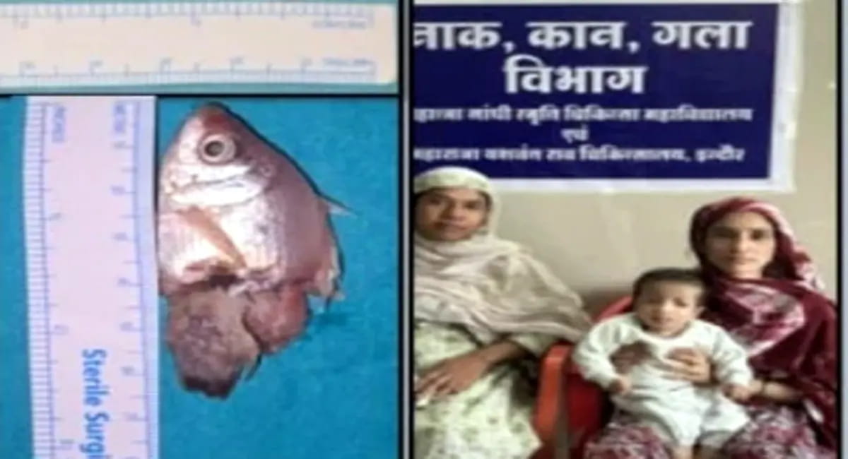 मासूम के गले में फंसी जिंदा मछली, सर्जरी कर बचाई जान