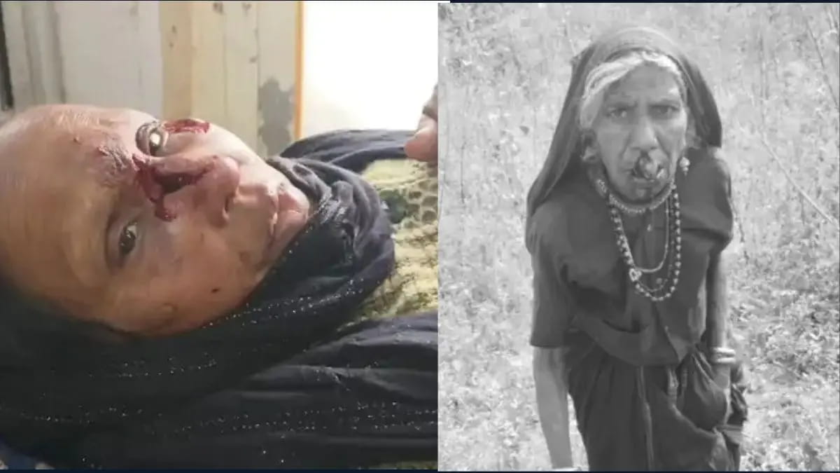 सेंधवा के दो गांवों में पागल कुत्ते ने 12 लोगों को काटा