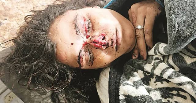 ग्वालियर में नशे की हालत में घर पहुंचे पति ने कैंची से काट दी पत्नी की नाक