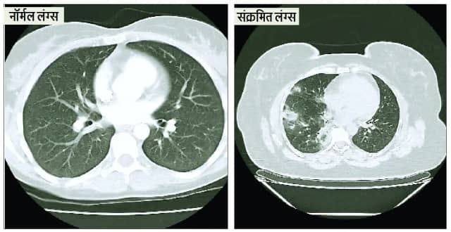 एडिनोवायरस-इन्फ्लुएंजा की दोहरी मार, निमोनिया और ब्रोंकाइटिस के मरीज बढ़े
