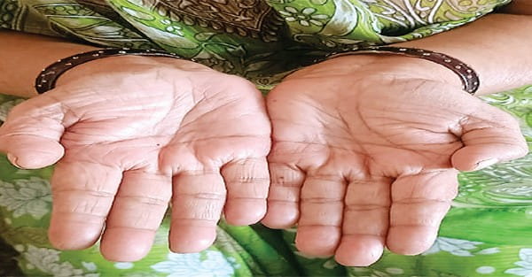 बुढ़ापे में हाथों की लकीरों ने भी छोड़ा साथ, कैसे हों ‘आयुष्मान’
