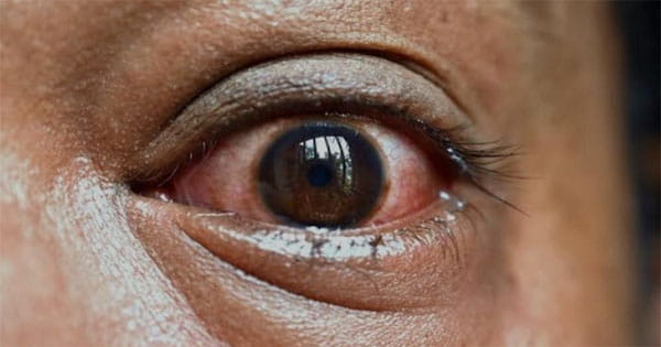 ब्लैक फंगस से 15 साल की लड़की की एक आंख की रोशनी चली गई थी, सर्जरी कर लौटाई
