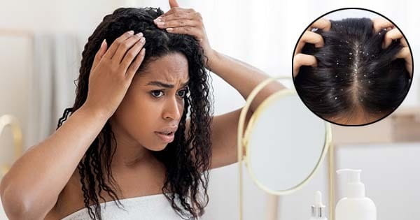 Hair Care Tips : डैंड्रफ से बचने के लिए करते हैं तेल का इस्तेमाल... हो जाएं सावधान, जान लें क्या करें और क्या न करें