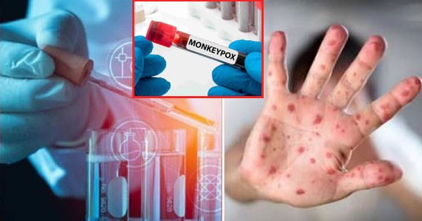 Monkeypox : एक और मरीज... क्या भारत में बढ़ रहा MPox का खतरा? केंद्र ने जारी की नई एडवाइजरी