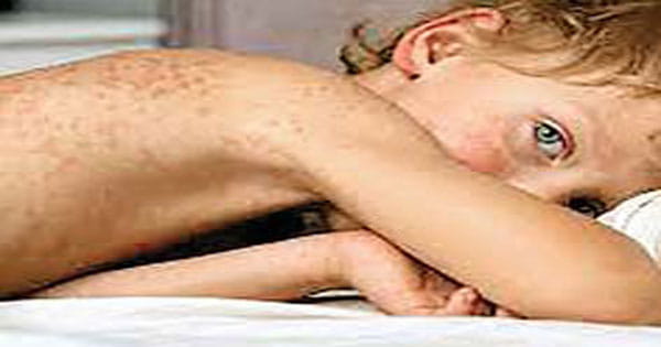 ब्रिटेन में फैल सकती है Mumps महामारी, अलर्ट किया गया जारी