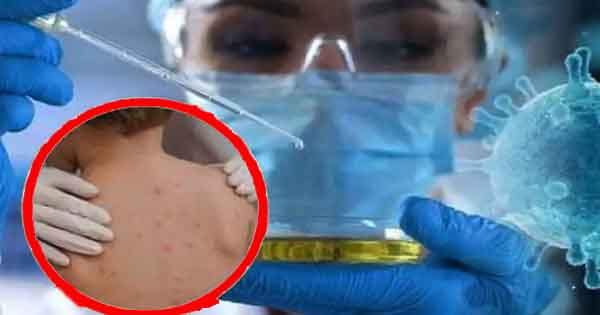 Monkeypox Alert : मंकीपॉक्स छोटे बच्चों के लिए ज्यादा खतरनाक, ICMR ने जारी की चेतावनी
