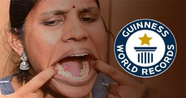 महिला के 38 दांत, गिनीज बुक में दर्ज हुआ रिकॉर्ड