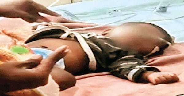 निमोनिया पीड़ित चार माह के मासूम को 21 बार गर्म सलाखों से दागा गया